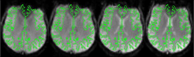 image003 The same subject scanned on four different scanners using the FBIRN methods (2009). Green lines indicate the grey/white matter boundary from a co-registered T1 scan.